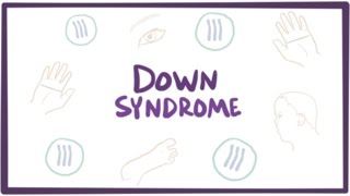 Down syndrome trisomy 21  causes symptoms diagnosis amp pathology [upl. by Evander341]