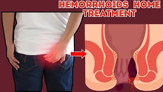 How To Get Rid Of Hemorrhoids Fast  How To Treat Hemorrhoids [upl. by Hoi]