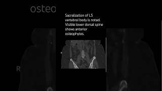 Sacralization of L5 vertebral body is noted spinesurgeon neurosurgeon orthopedicsurgeon [upl. by Denver]