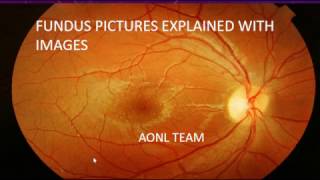 Fundus images explained by an ophthalmologist [upl. by Nuahs]