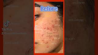 mesotherapy treatment before and after skincare acnescarremoval beforeandafter skincare results [upl. by Giacobo]