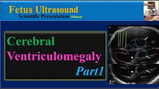 Fetus Ultrasound Cerebral Ventriculomegaly Part1 [upl. by Nydnarb]