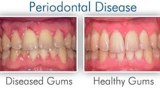 quotSaveYourSmile Understanding Periodontitis and Howto Prevent Itquotgumdisease oralhealthdentist [upl. by Inva]