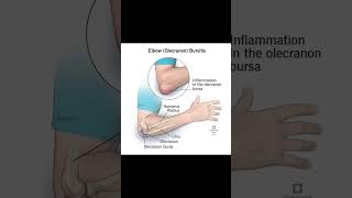 Elbow bursitisexcercisethephysiodoctoranatomyphysiotharapisthumananatomysportselbowpain [upl. by Leidgam]