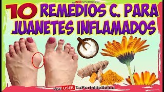 COMO ELIMINAR LOS JUANETES con Estos 10 Remedios Caseros Para los JUANETES INFLAMADOS [upl. by Anita]