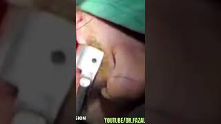 Lt Buccal Haemangioma Excisionhttpsyoutubecomfazaliwahid9397siTsINz7FGtR0c8p [upl. by Ssew]