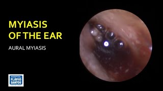 MYIASIS OF THE EAR [upl. by Babbette]