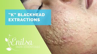 Blackheads Whiteheads Extractions on quotKquot Part 1 [upl. by Airamesor]