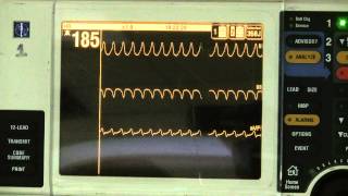 Ventricular Tachycardia [upl. by Abrahan]