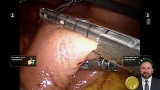 Robotic RouxenY repair of E4 bile duct injury following laparoscopic cholecystectomy [upl. by Petty]