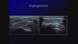 Sonography of Common Shoulder and Elbow Pathology [upl. by Lodhia]