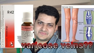 Homeopathic medicine for varicose veins explain [upl. by Tremml]