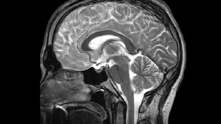 The Ventricles Neuroanatomy Video Lab  Brain Dissections [upl. by Cloris]