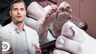 Hongos severos que impactaron a los médicos  Los pies me están matando  Discovery En Español [upl. by Acsicnarf]