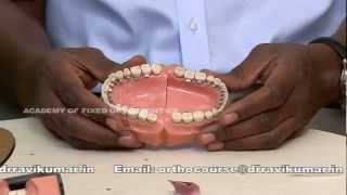 Lingual Orthodontics Course [upl. by Massingill]