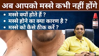 मस्सो का इलाज  Warts on Face  Best Treatment of Warts  Best Homeopathic Dr Aashis Jain [upl. by Ramso]