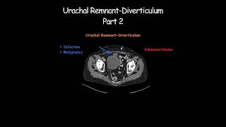 Urachal RemnantDiverticulum Part 2 radiology radiologist embryology urinarybladder [upl. by Yrroc666]