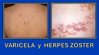 Varicela y Herpes Zóster [upl. by Bo]