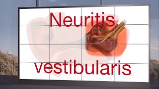 Neuritis vestibularis [upl. by Marih]