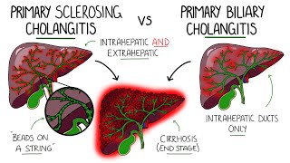 Primary Sclerosing Cholangitis v Primary Biliary Cholangitis Primary Biliary Cirrhosis [upl. by Norat]