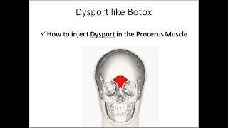 How to inject Dysport in the Procerus Muscle [upl. by Niraa]