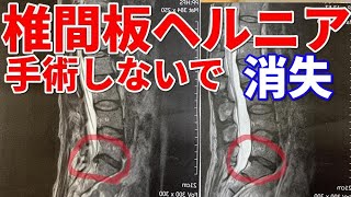 腰椎椎間板ヘルニアが手術せずに消失したMRI画像とその理由について解説します。代々木上原整体 [upl. by Churchill]