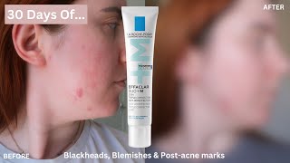 30 DAYS OF La RochePosay Effaclar Duo for Blemishes Blackheads amp PostAcne Marks One Month Review [upl. by Ahtekal849]