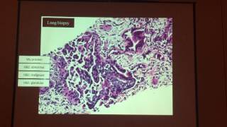 Small biopsies big deal practical approach to lung cancer diagnosis [upl. by Roderigo]