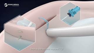 AllInside Meniscus Repair Procedures with Double Medical MLink System  StepbyStep Animation [upl. by Sturdivant]